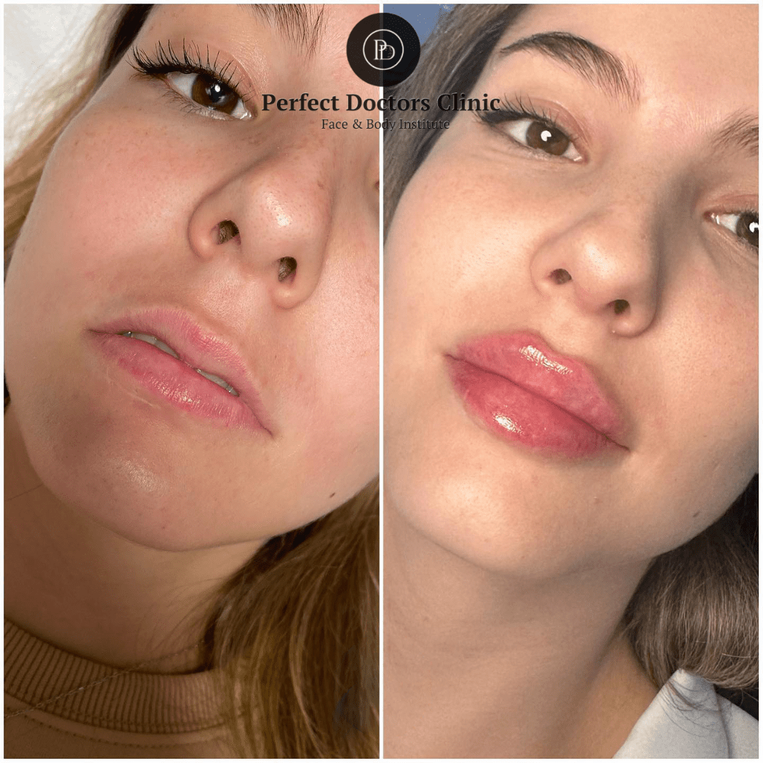 Juvederm in Dubai
